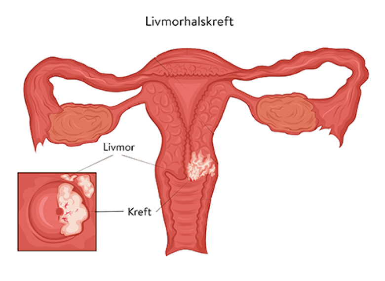 Livmorhalskreft - informasjonskjelder til diagnostikk og behandling