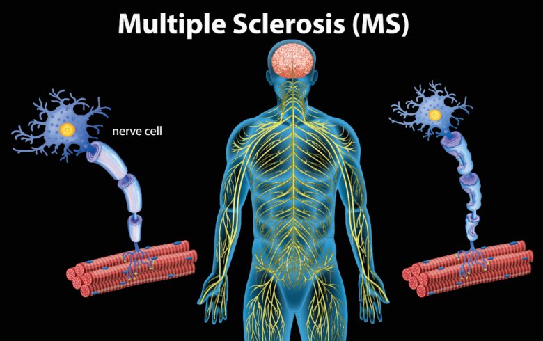 Nyttige informasjonskilder om multippel sklerose (MS)