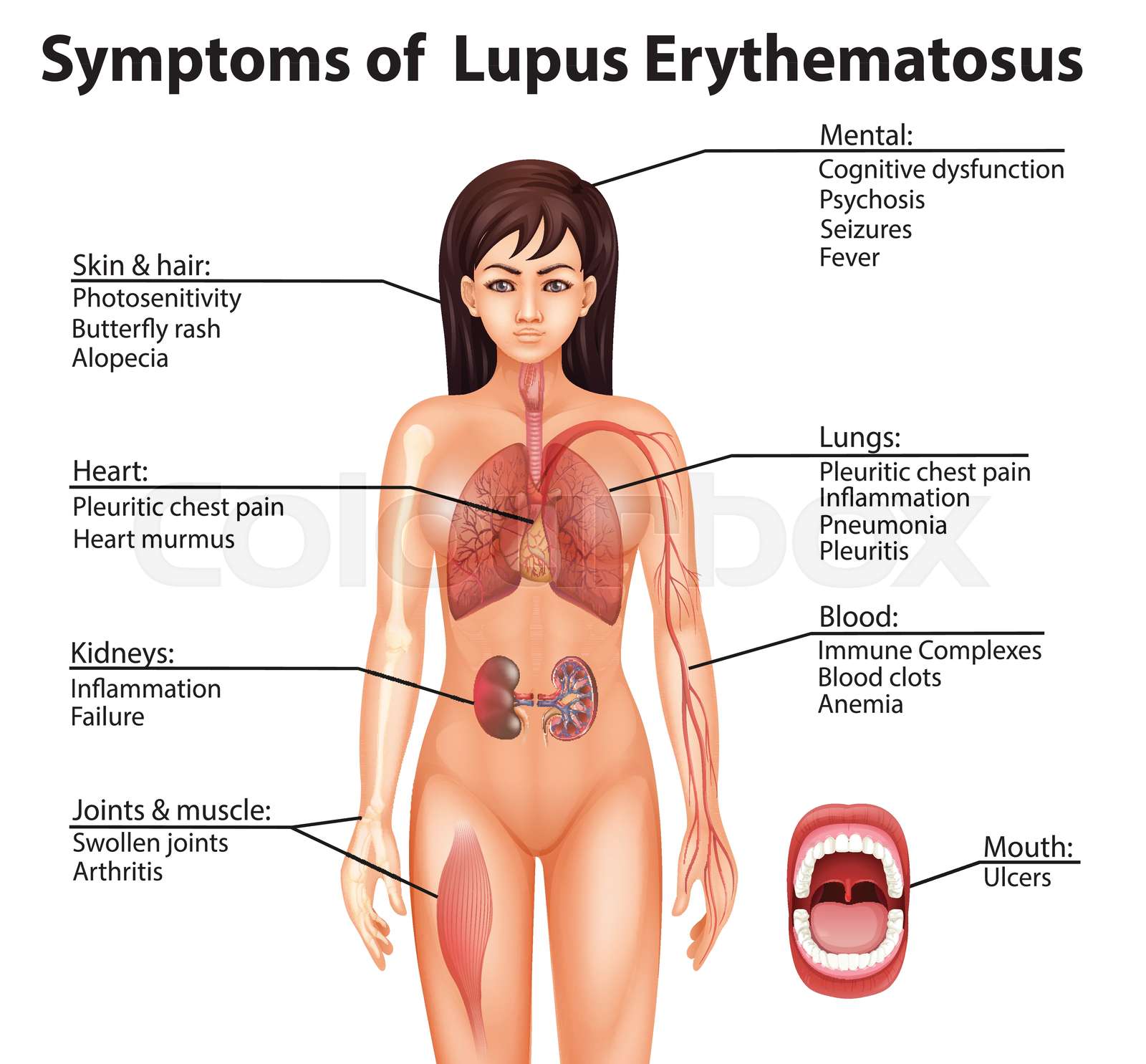 Lupus symptomer og utslag.jpg