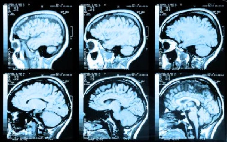 Cochrane spesialsamling om hjernehelse: Komorbiditet psykisk helse og nevrologi