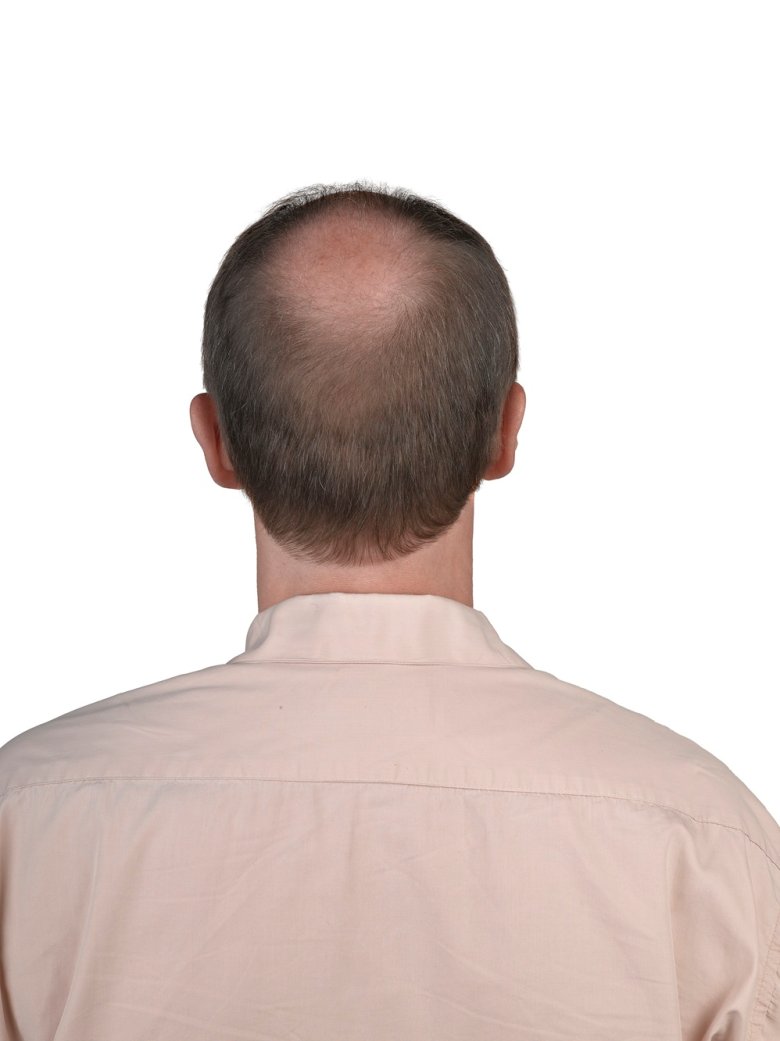 Risiko for selvmordstanker ved bruk av legemidler mot hårtap og forstørret prostata (Direktoratet for medisinske produkter)