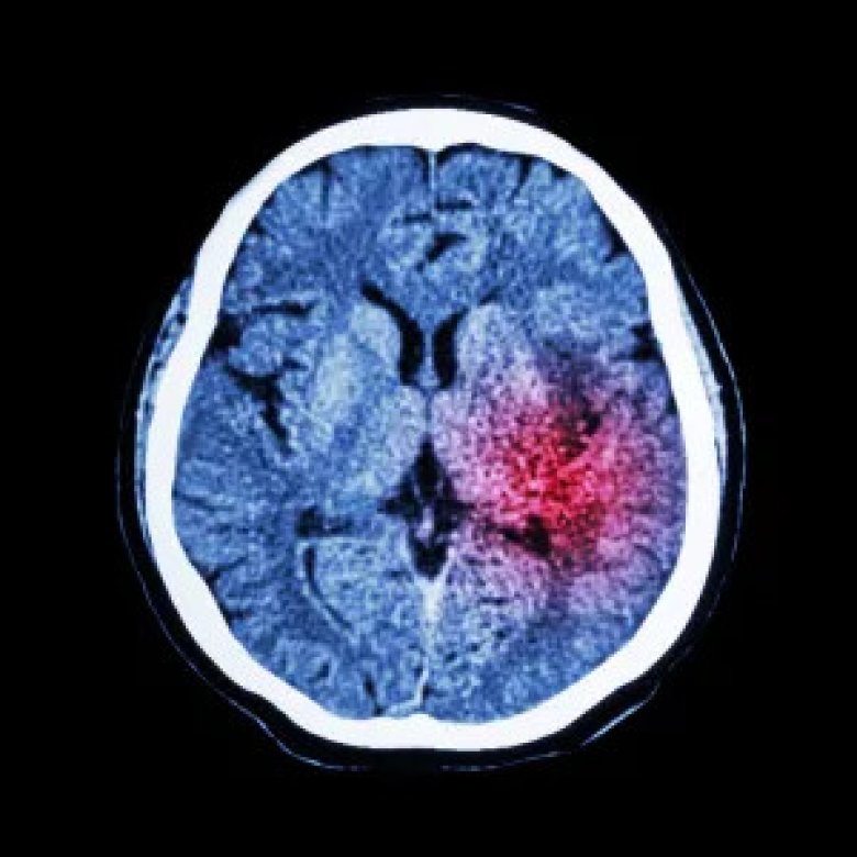 Stemningsstabilisatorer og risiko for hjerneslag hos personer med bipolar lidelse