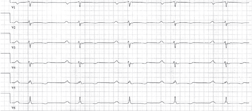 Hvile-EKG med AV-blokk I, intraventrikulært ledningshinder og T-bølgeforandringer.