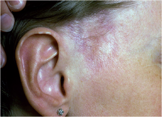 Bilde 4. Annulære sarkoidoseforandringer (Sandström T, Eklund A, red. Lungmedisin. Studentlitteratur 2009; 220).