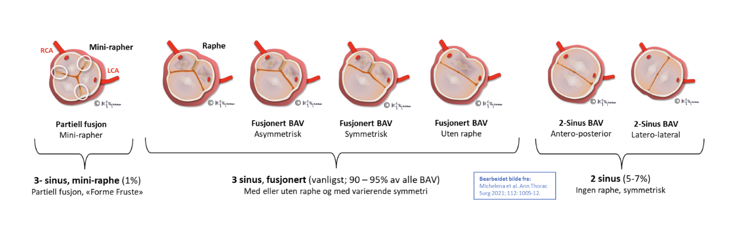Bikuspid aortaklaff.png