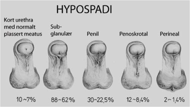 hypos