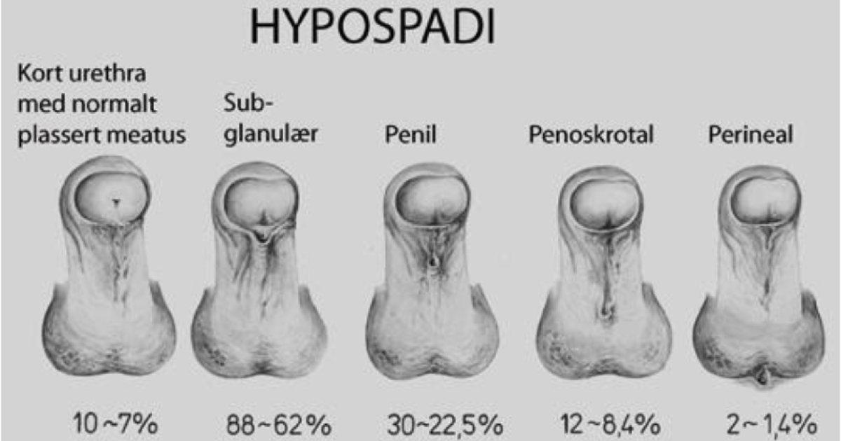 12.13 Hypospadi Helsebiblioteket