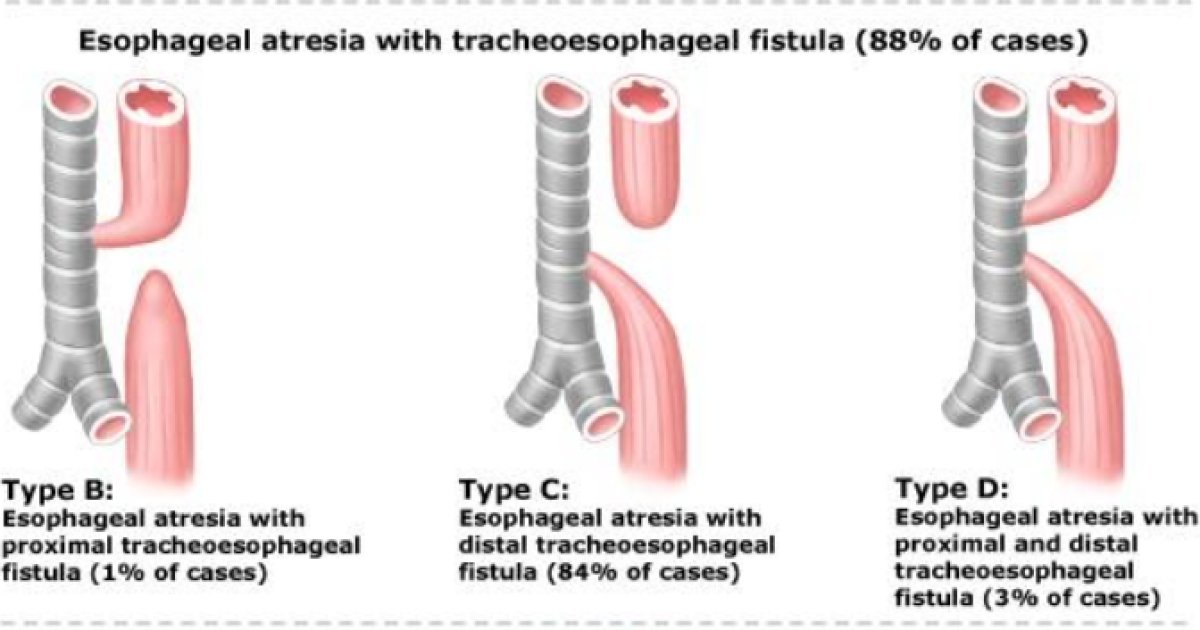13.7 Øsofagusatresi og trakeoøsofagal fistel - Helsebiblioteket