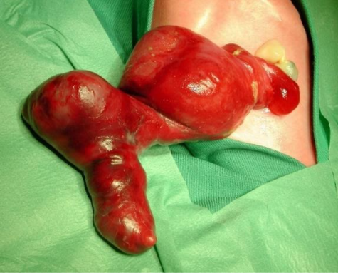 ugastroschise