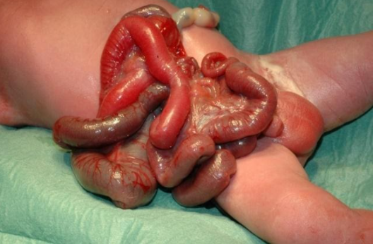 gastroschise