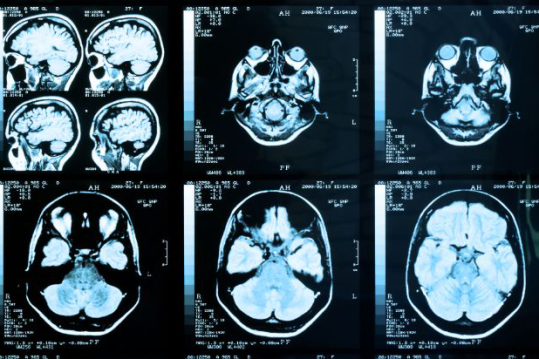 Hjernestammen kan ha betydning for psykiatriske sykdommer